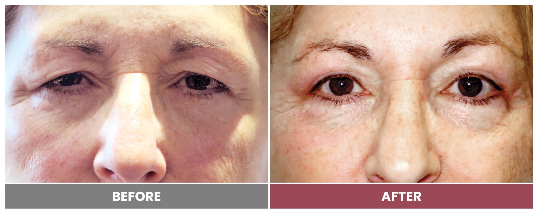 Upper Blepharoplasty - Case 26